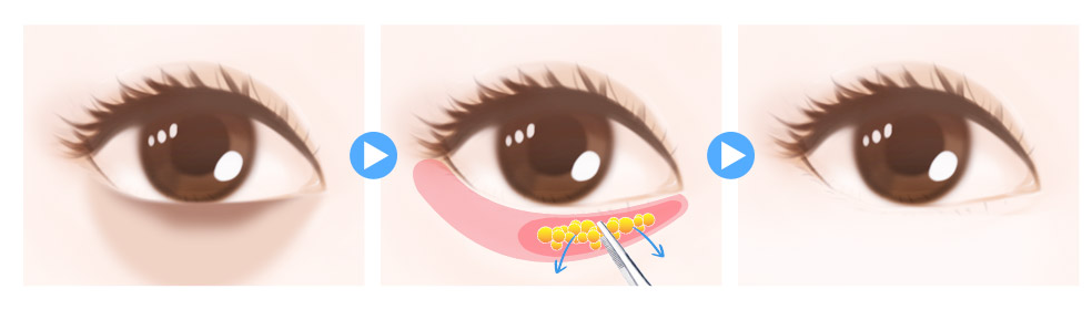 비절개 눈밑 지방재배치 — 시술 전·시술·후